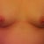 Before thank goodness I was having the mole removed