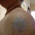 3 weeks after 6th treatment