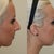 Here is my before and after (5 weeks post surgery)