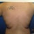 Back pre-op
