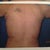 Back 1 day after procedure