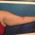 Left arm front pre-op