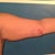 Left arm 1 day after