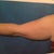 Left arm back side pre-op