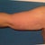 Left arm back view 1 day after