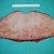 The skin removed during the procedure.  UGH