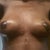 Close up of breast lift (no implants) at 4 weeks post op