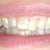 June 2012-  1st upper tray without buttons (you can't see it too well, but my top front tooth will have 2 buttons on it!  Not too happy!)  2nd Tray on bottom teeth with buttons.