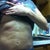 2 weeks post op