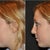 My current profile vs. the morphed profile.  Obviously my new nose won't look exactly like this, but it's a start.