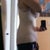 5 days post op from the side you can see how swollen my flanks are. He took out a whole two liters! I am suprised I am not bruised at all !!