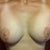 5 months post op