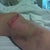 Road rash.