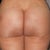 3 weeks post op 2