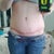 My incision. Looks darker from that angle because it is still a big ridge. Actual line is great except above my groin. 5 weeks.
