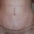 4 weeks post-op
