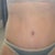 4 Weeks post-op.  Still have some swelling and belly button redness, but I think it's looking pretty good.  Look how low the bikini is. WOO HOO!!!!