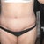 After - 2 weeks post-op tummy tuck and lipo