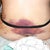 Lipo bruising - 5 days post-op