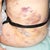 Lipo bruising - 5 days post-op