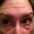 Wrinkles are back, all negative botox side effects show no relief. Getting worse in fact.