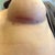 10 weeks post-op