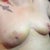 Incisions are healing well at 2 weeks after surgery, except one area.