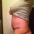 16 days post op - featuring swelling and a seroma. 
:-(