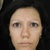 3 months after rhinoplasty. Twisted, retracted columella.