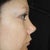 profile after rhinoplasty (no columella, excessive turn up)