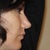 BEFORE  rhinoplasty profile (much BETTER!!)