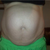 Pre-op Front (double ew)