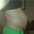 Pre-op Side (ew)