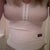 About 2 days post op. My boobs are swollen...they look big right now but you can tell they will go down to a nice size.