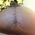 My scar , slowly healing