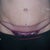 scar right after vbeam treatment