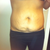 front view 2 weeks pre op
