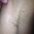 Left armpit incision