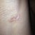 Right armpit incision