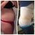 Before vs. 1 week post op