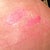 My blister butt marks :-( still showing after 5 weeks....