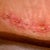 Eeww this is what a infection looks like. Sorry kinda graphic