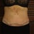 Day five post OP.