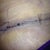 Incision looking pretty good 8 days PO