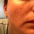 Here is a close up 3 days post-procedure.  You can see the dark freckles as they are at the surface, about to flake off. Taken Sunday, Feb 19th.