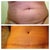 Tummy before and after