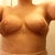 23 days post-op