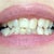 April 2012 before Invisalign.