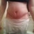 18 days post op-bandages off