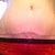My scar.